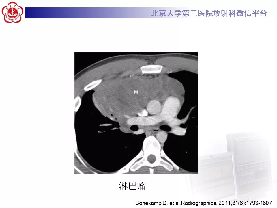 【病例】纵隔巨大淋巴结增生症1例CT