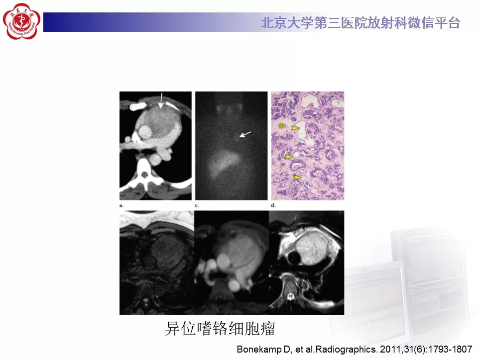 【病例】纵隔巨大淋巴结增生症1例CT