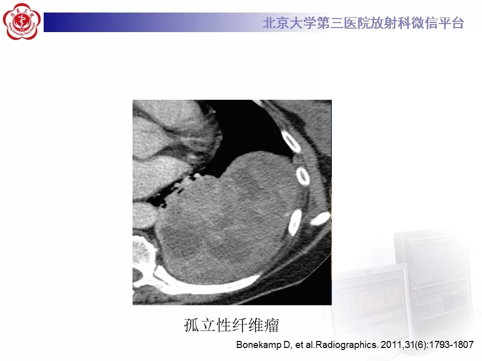 【病例】纵隔巨大淋巴结增生症1例CT