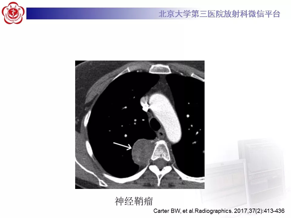 【病例】纵隔巨大淋巴结增生症1例CT