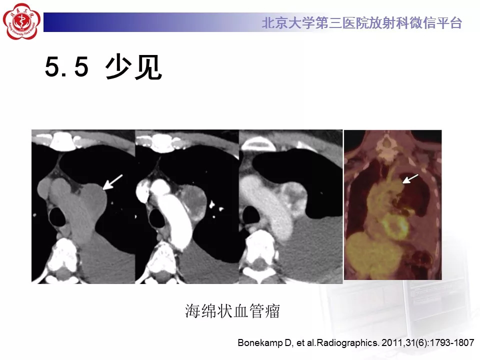 【病例】纵隔巨大淋巴结增生症1例CT