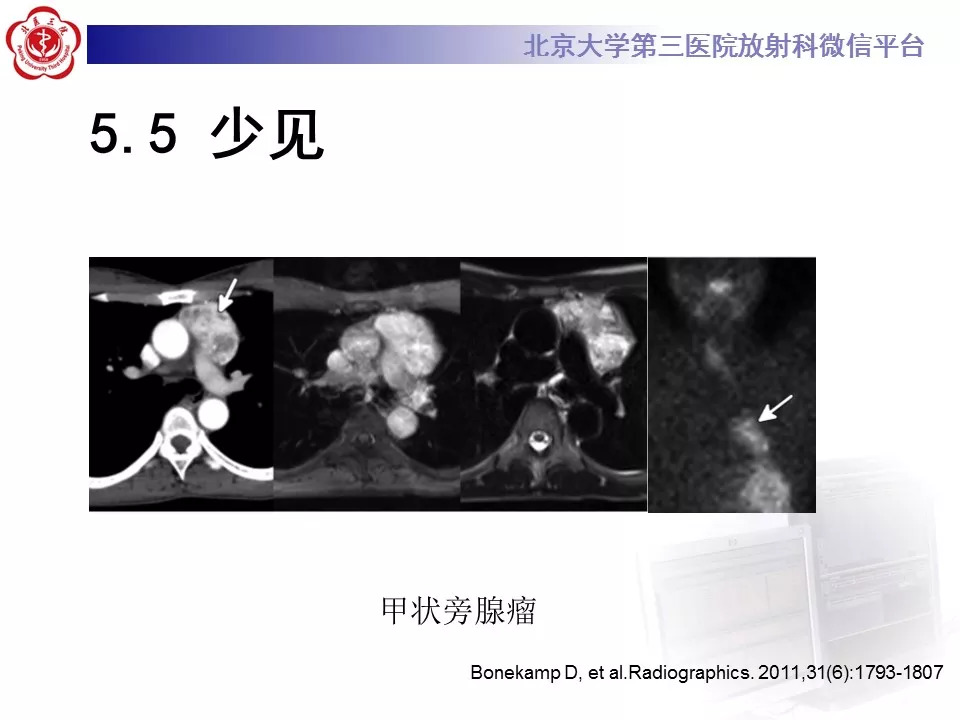 【病例】纵隔巨大淋巴结增生症1例CT