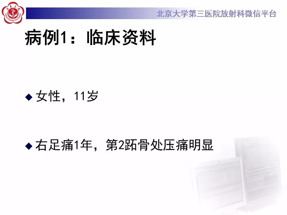 【病例】跖骨头缺血性坏死1例X线MR