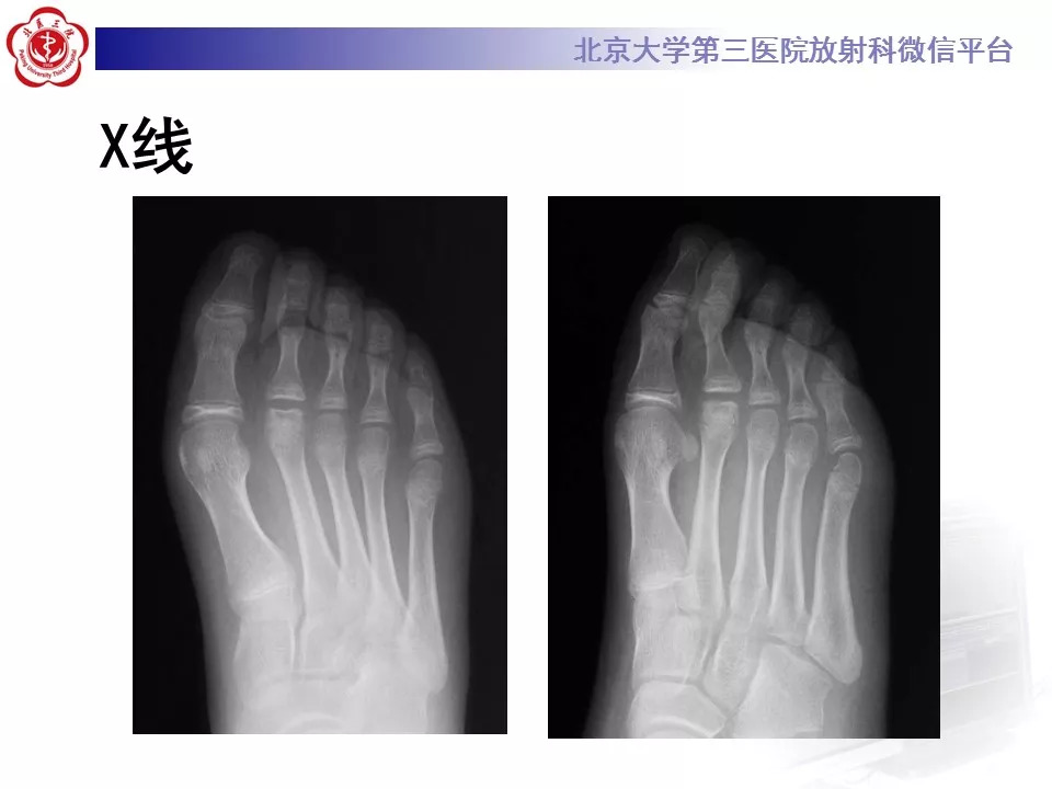 【病例】跖骨头缺血性坏死1例X线MR