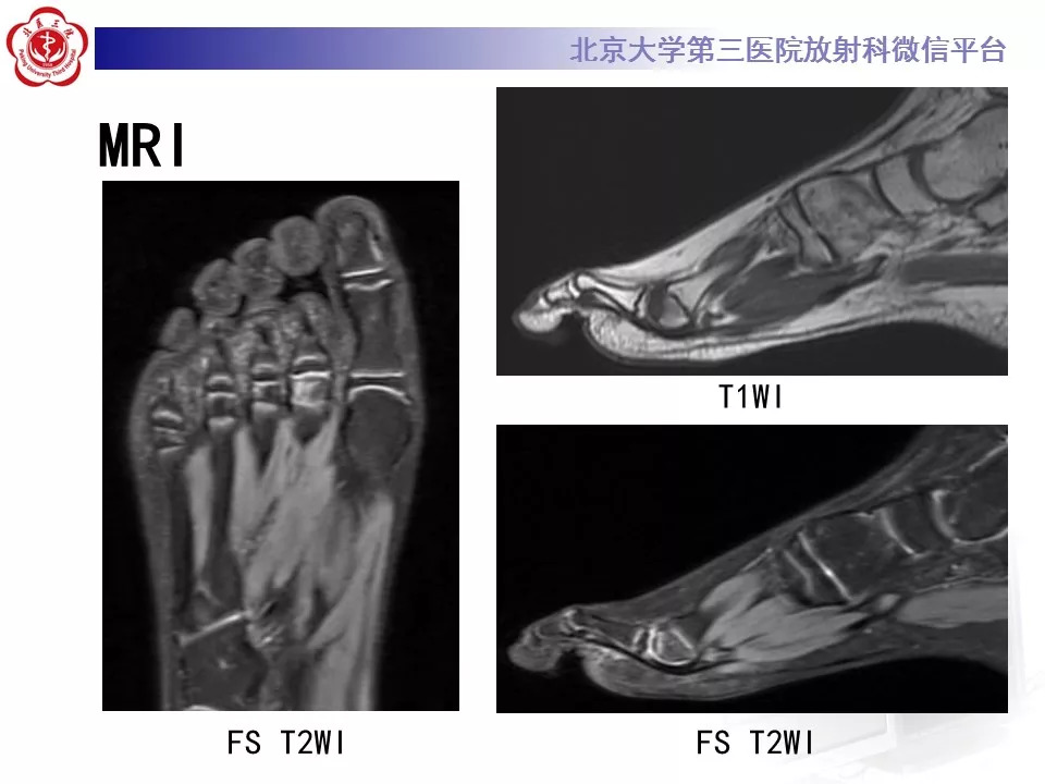 【病例】跖骨头缺血性坏死1例X线MR