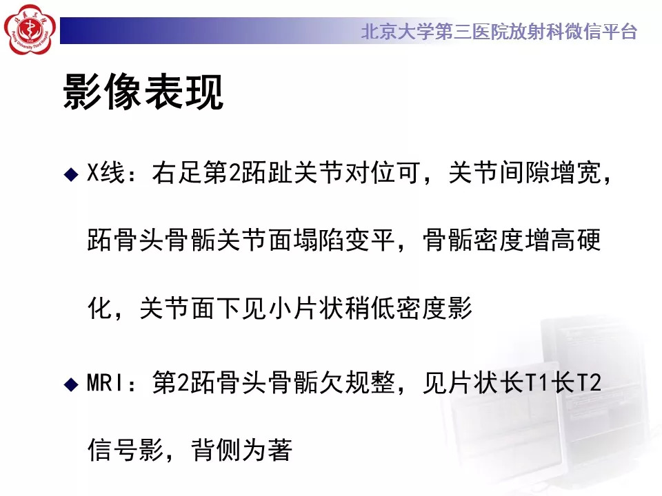 【病例】跖骨头缺血性坏死1例X线MR