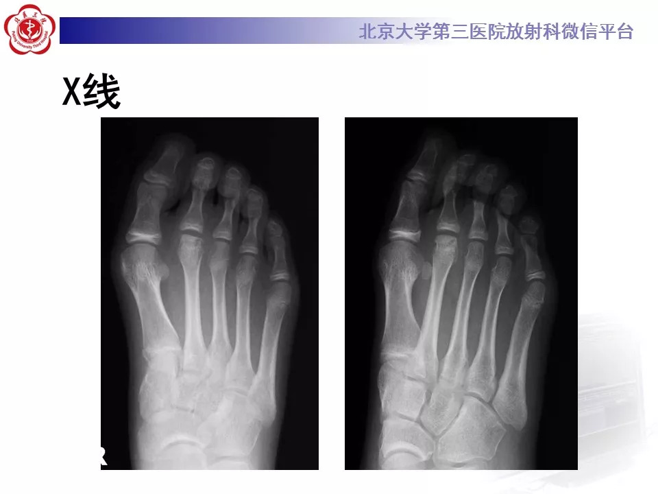 【病例】跖骨头缺血性坏死1例X线MR