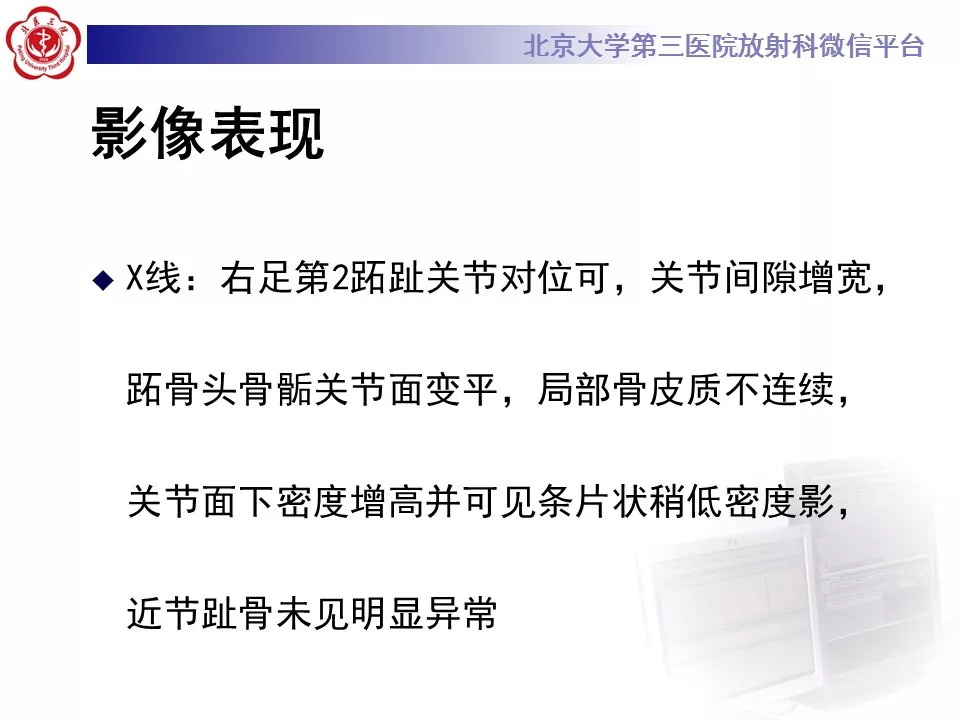 【病例】跖骨头缺血性坏死1例X线MR