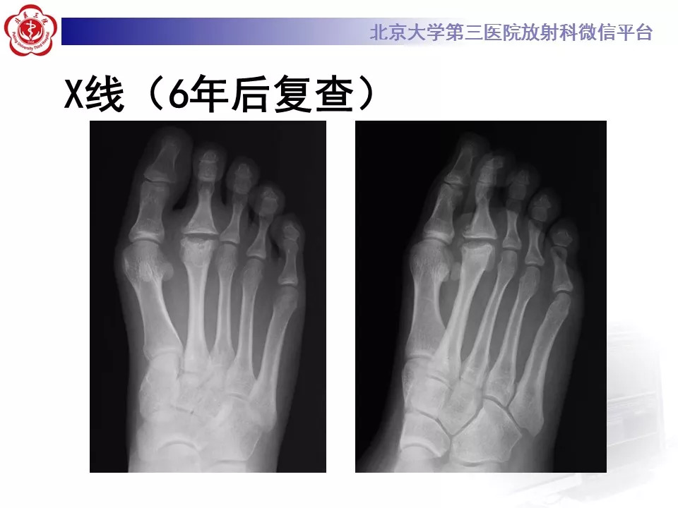 【病例】跖骨头缺血性坏死1例X线MR