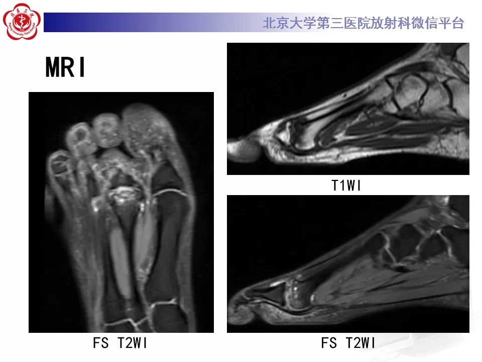 【病例】跖骨头缺血性坏死1例X线MR