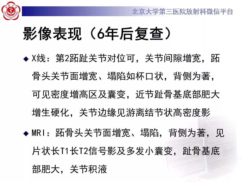 【病例】跖骨头缺血性坏死1例X线MR