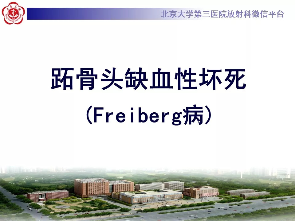 【病例】跖骨头缺血性坏死1例X线MR