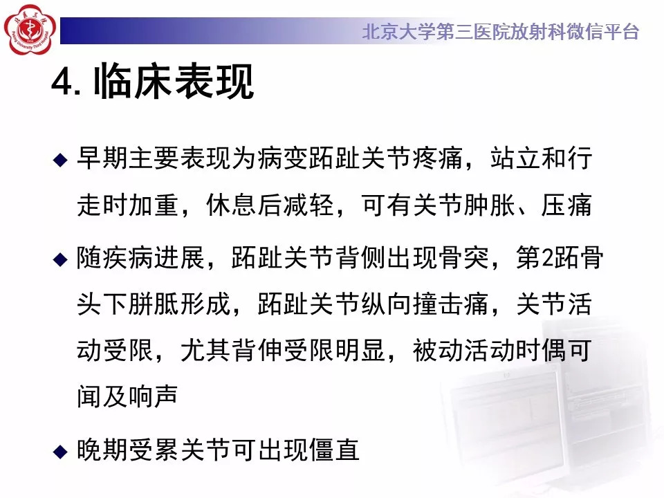 【病例】跖骨头缺血性坏死1例X线MR