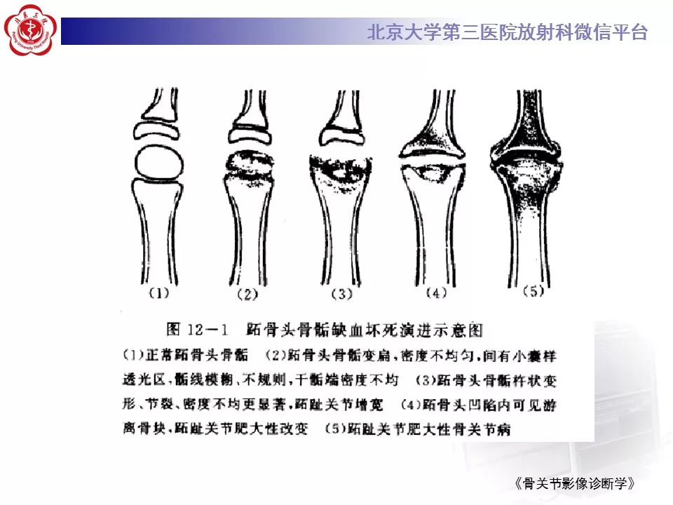 【病例】跖骨头缺血性坏死1例X线MR