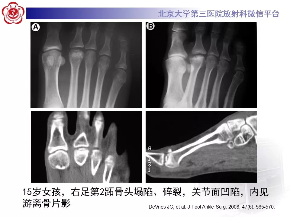 【病例】跖骨头缺血性坏死1例X线MR