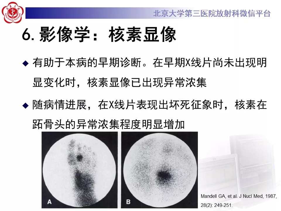 【病例】跖骨头缺血性坏死1例X线MR