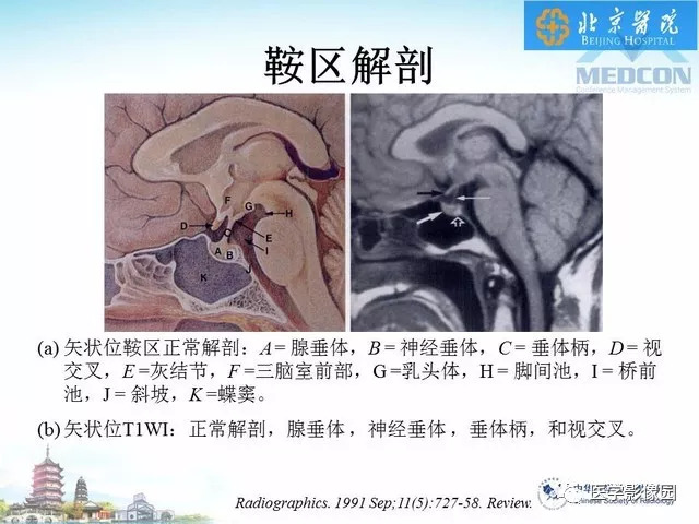 【PPT】鞍区非肿瘤性病变影像诊断