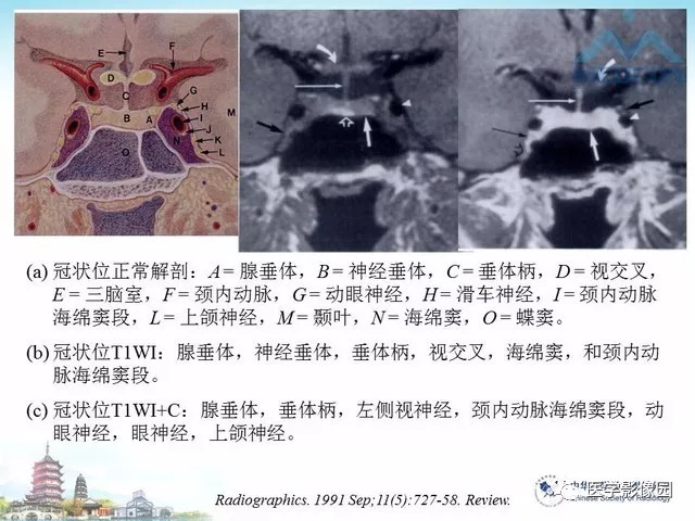 【PPT】鞍区非肿瘤性病变影像诊断