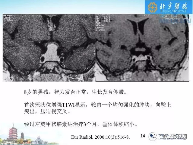 【PPT】鞍区非肿瘤性病变影像诊断