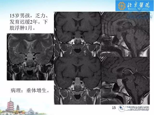【PPT】鞍区非肿瘤性病变影像诊断