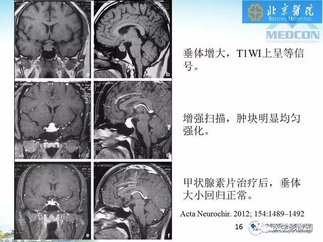 【PPT】鞍区非肿瘤性病变影像诊断
