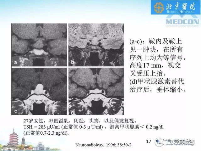【PPT】鞍区非肿瘤性病变影像诊断