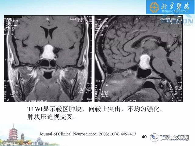 【PPT】鞍区非肿瘤性病变影像诊断