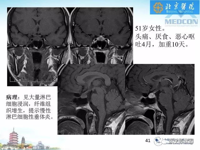 【PPT】鞍区非肿瘤性病变影像诊断