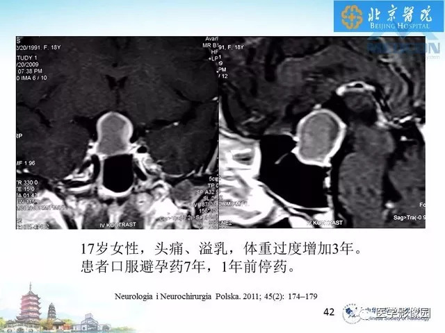 【PPT】鞍区非肿瘤性病变影像诊断