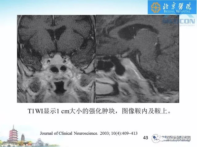 【PPT】鞍区非肿瘤性病变影像诊断