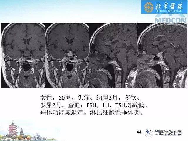 【PPT】鞍区非肿瘤性病变影像诊断