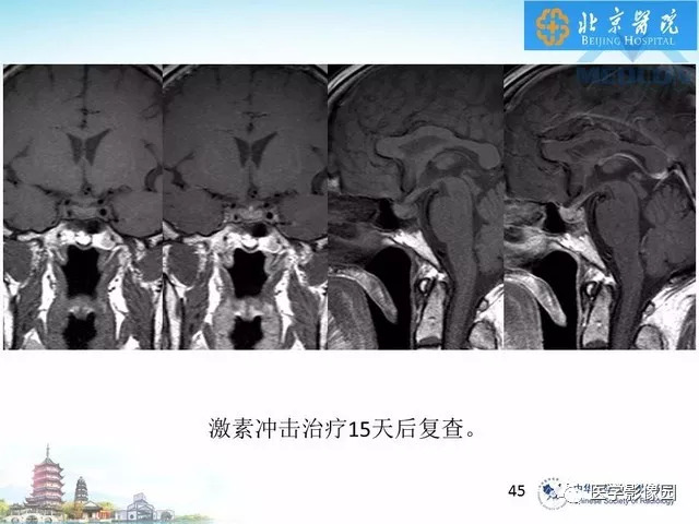 【PPT】鞍区非肿瘤性病变影像诊断