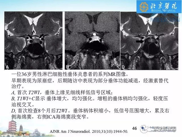 【PPT】鞍区非肿瘤性病变影像诊断