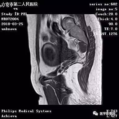 【病例】葡萄胎1例MR影像表现 【病例】葡萄胎1例MR影像表现