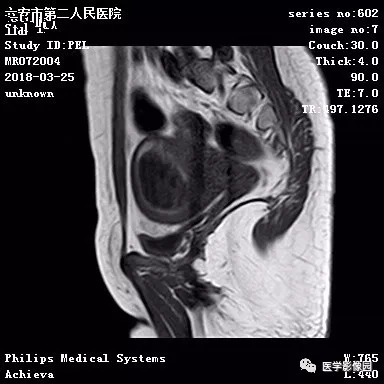 【病例】葡萄胎1例MR影像表现 【病例】葡萄胎1例MR影像表现