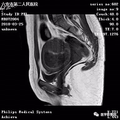 【病例】葡萄胎1例MR影像表现 【病例】葡萄胎1例MR影像表现