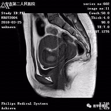 【病例】葡萄胎1例MR影像表现 【病例】葡萄胎1例MR影像表现