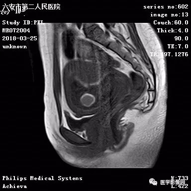 【病例】葡萄胎1例MR影像表现 【病例】葡萄胎1例MR影像表现