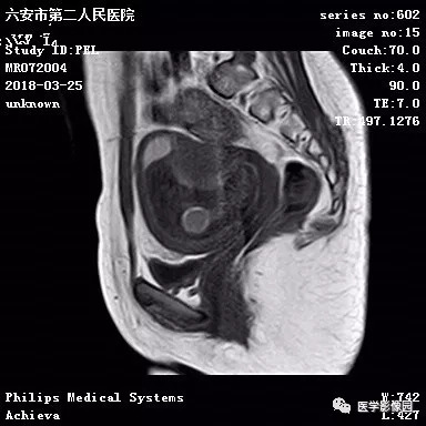 【病例】葡萄胎1例MR影像表现 【病例】葡萄胎1例MR影像表现