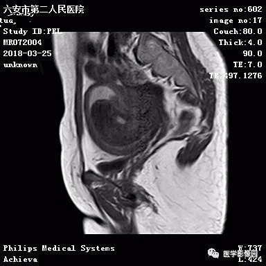 【病例】葡萄胎1例MR影像表现 【病例】葡萄胎1例MR影像表现