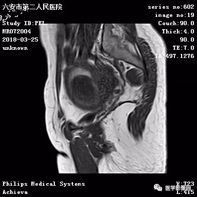 【病例】葡萄胎1例MR影像表现 【病例】葡萄胎1例MR影像表现