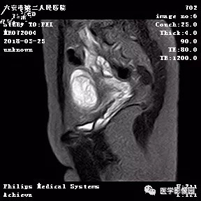 【病例】葡萄胎1例MR影像表现 【病例】葡萄胎1例MR影像表现