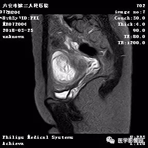 【病例】葡萄胎1例MR影像表现 【病例】葡萄胎1例MR影像表现