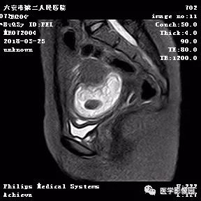 【病例】葡萄胎1例MR影像表现 【病例】葡萄胎1例MR影像表现