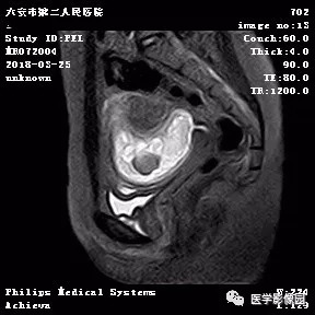 【病例】葡萄胎1例MR影像表现 【病例】葡萄胎1例MR影像表现