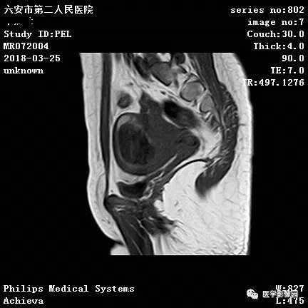 【病例】葡萄胎1例MR影像表现 【病例】葡萄胎1例MR影像表现