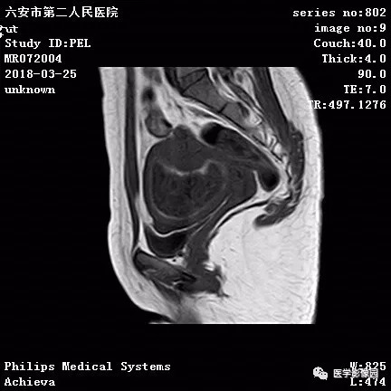 【病例】葡萄胎1例MR影像表现 【病例】葡萄胎1例MR影像表现