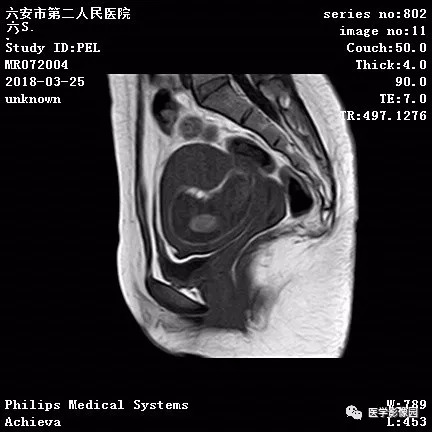 【病例】葡萄胎1例MR影像表现 【病例】葡萄胎1例MR影像表现
