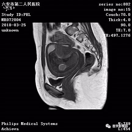 【病例】葡萄胎1例MR影像表现 【病例】葡萄胎1例MR影像表现