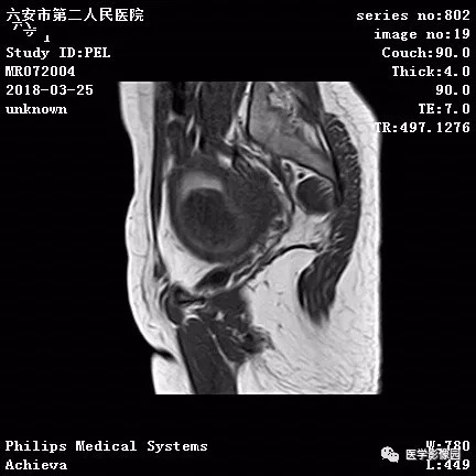 【病例】葡萄胎1例MR影像表现 【病例】葡萄胎1例MR影像表现
